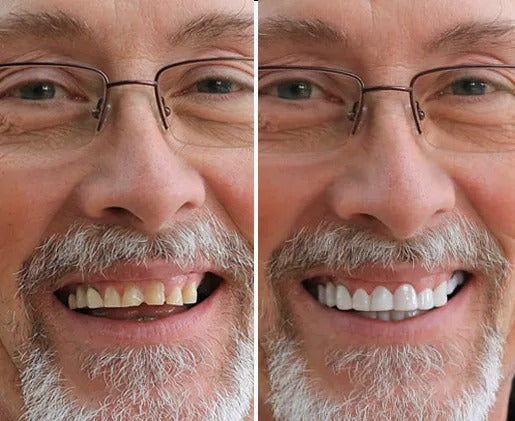 Solavane™ Snap-On Veneers