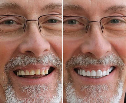 Solavane™ Snap-On Veneers