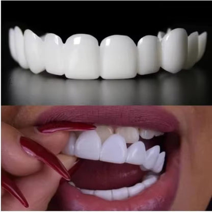 Solavane™ Snap-On Veneers